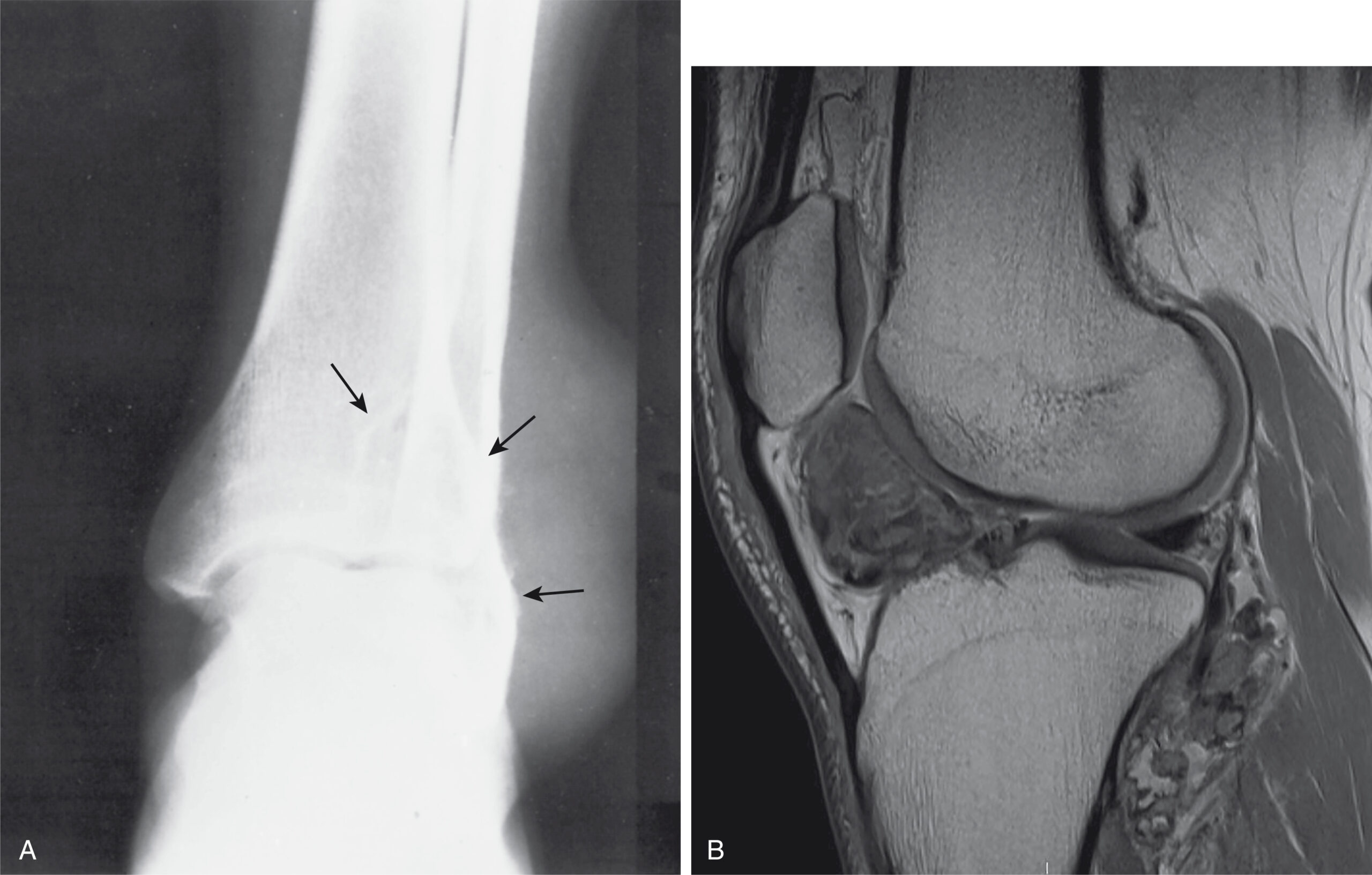 Two scans A and B of tenosynovial giant cell tumor, one radiograph of the ankle with distal bone destruction, and one magnetic resonance imaging scan of the knee joint replaced by a mass.