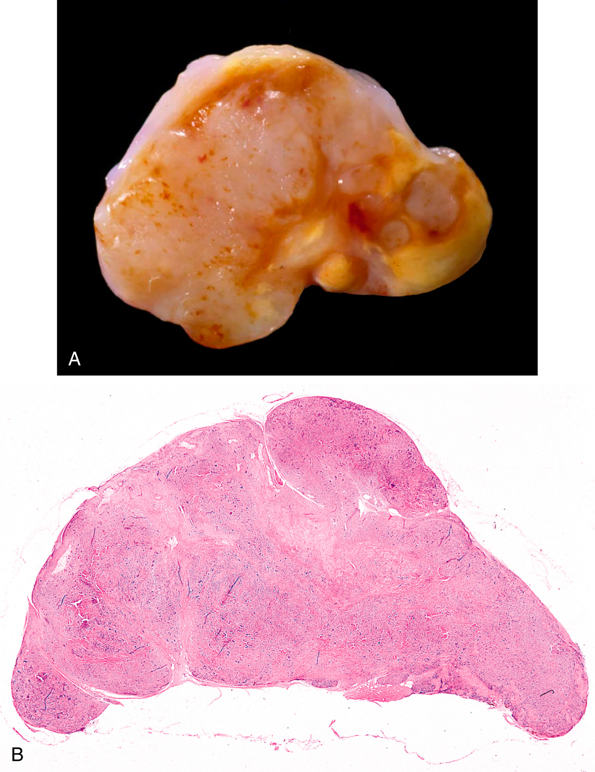 A set of two sections labeled A and B of localized tenosynovial giant cell tumor, one gross specimen with nodular surface and one microscopic view with lobular and circumscribed structure.