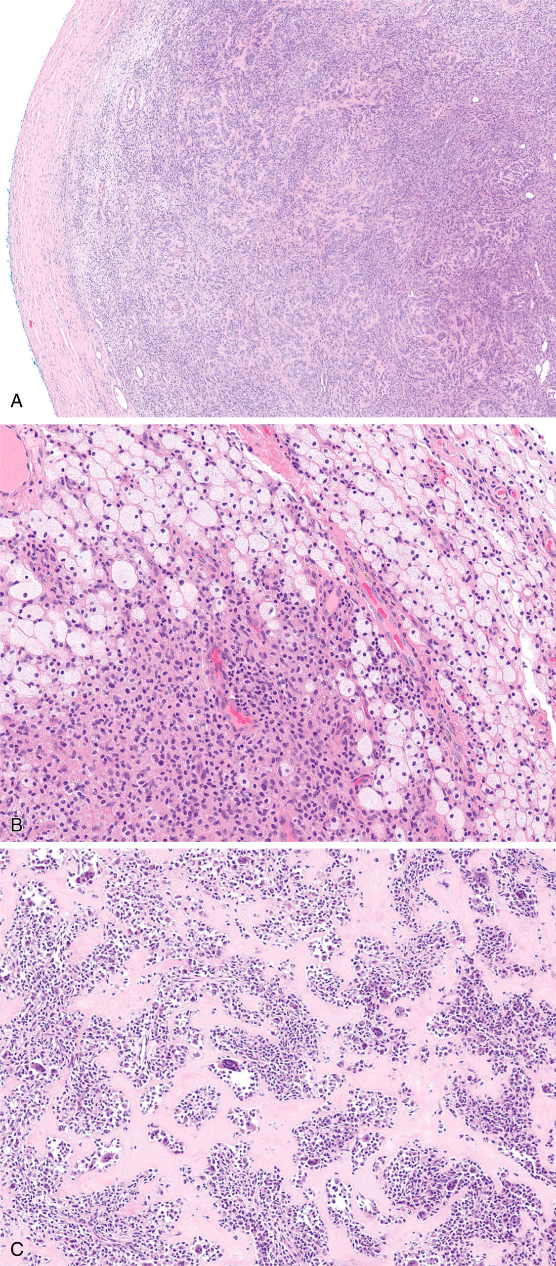 Three microscopic views depict a donated lesion with a fibrous capsule, peripheral lipidated cells, and central nests of synoviocytes, giant cells, and histiocytes. The three microscopic views labeled A, B, and C of a densely cellular tumor, a primitive neuroectodermal tumor, are stained to highlight cellular structures. Panel A presents a low-power view of the tumor, revealing a large, circumscribed mass with high cellularity and a relatively uniform appearance, encased by a thin, fibrous capsule at the periphery. Panel B illustrates the characteristic small, round cells with scant cytoplasm and darkly staining nuclei, arranged in sheets and clusters, with occasional stromal blood vessels visible amidst the tumor cells and a suggestion of early cellular death in some areas. Panel C provides an even higher magnification, emphasizing the densely packed nature of these primitive-appearing cells, the high nuclear-to-cytoplasmic ratio, and the lack of significant differentiation, features consistent with a high-grade neuroectodermal malignancy.