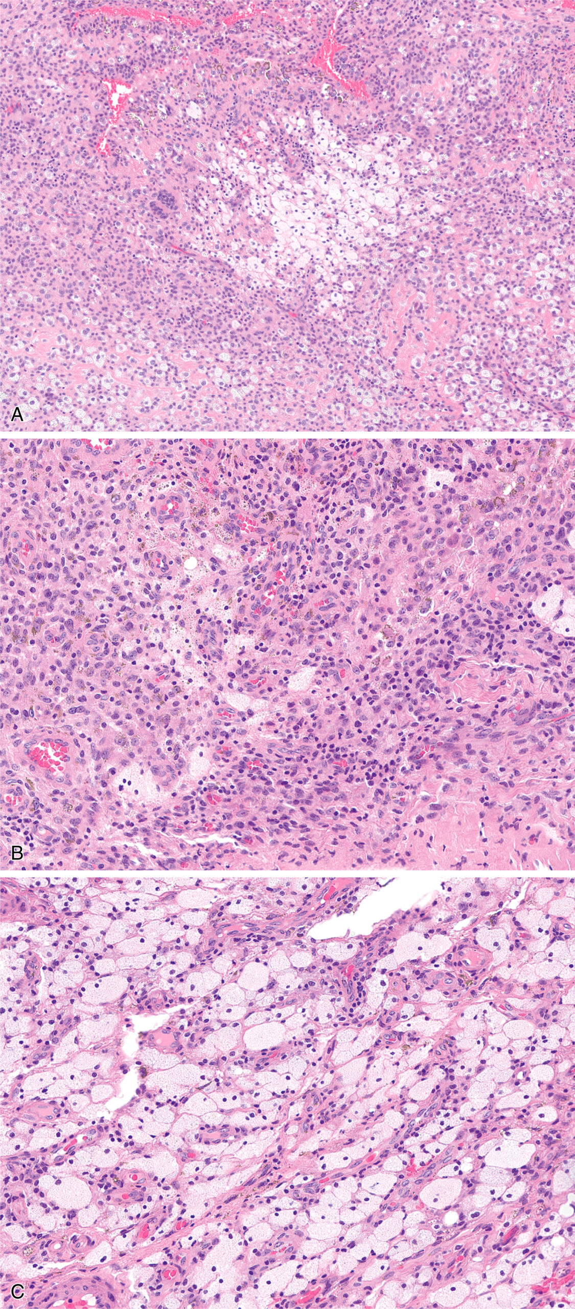 Four microscopic slides display a localized tenosynovial giant cell tumor with a mixed cell population, including siderophages and foamy macrophages. The topmost panel A displays a region of the tumor at moderate magnification, characterized by a heterogeneous population of cells within a fibrous stroma, exhibiting moderate cellularity and a somewhat nodular architecture. Panel B offers a higher magnification view, highlighting the mixed cellularity of the tumor, including mononuclear stromal cells with oval nuclei and pale cytoplasm, interspersed with distinctive siderophages containing granular material, indicative of prior hemorrhage. Panel C provides a further magnified perspective, demonstrating a significant presence of large, foamy macrophages with abundant vacuolated cytoplasm, contributing to the diverse cellular landscape of this benign soft tissue neoplasm. Panel D is a histological section of a tenosynovial giant cell tumor containing a moderately cellular background composed of mononuclear stromal cells.