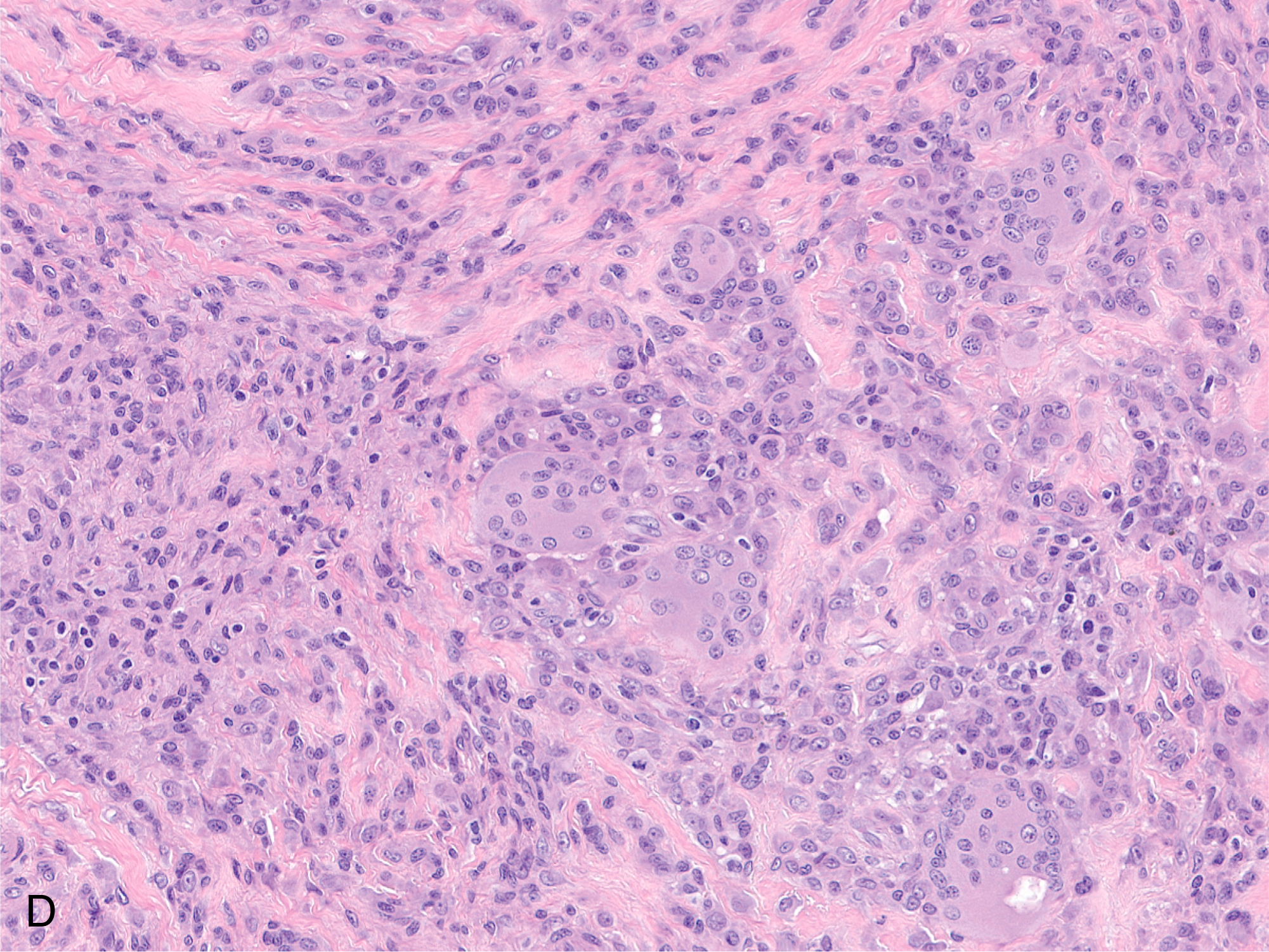 Four microscopic slides display a localized tenosynovial giant cell tumor with a mixed cell population, including siderophages and foamy macrophages. The topmost panel A displays a region of the tumor at moderate magnification, characterized by a heterogeneous population of cells within a fibrous stroma, exhibiting moderate cellularity and a somewhat nodular architecture. Panel B offers a higher magnification view, highlighting the mixed cellularity of the tumor, including mononuclear stromal cells with oval nuclei and pale cytoplasm, interspersed with distinctive siderophages containing granular material, indicative of prior hemorrhage. Panel C provides a further magnified perspective, demonstrating a significant presence of large, foamy macrophages with abundant vacuolated cytoplasm, contributing to the diverse cellular landscape of this benign soft tissue neoplasm. Panel D is a histological section of a tenosynovial giant cell tumor containing a moderately cellular background composed of mononuclear stromal cells.