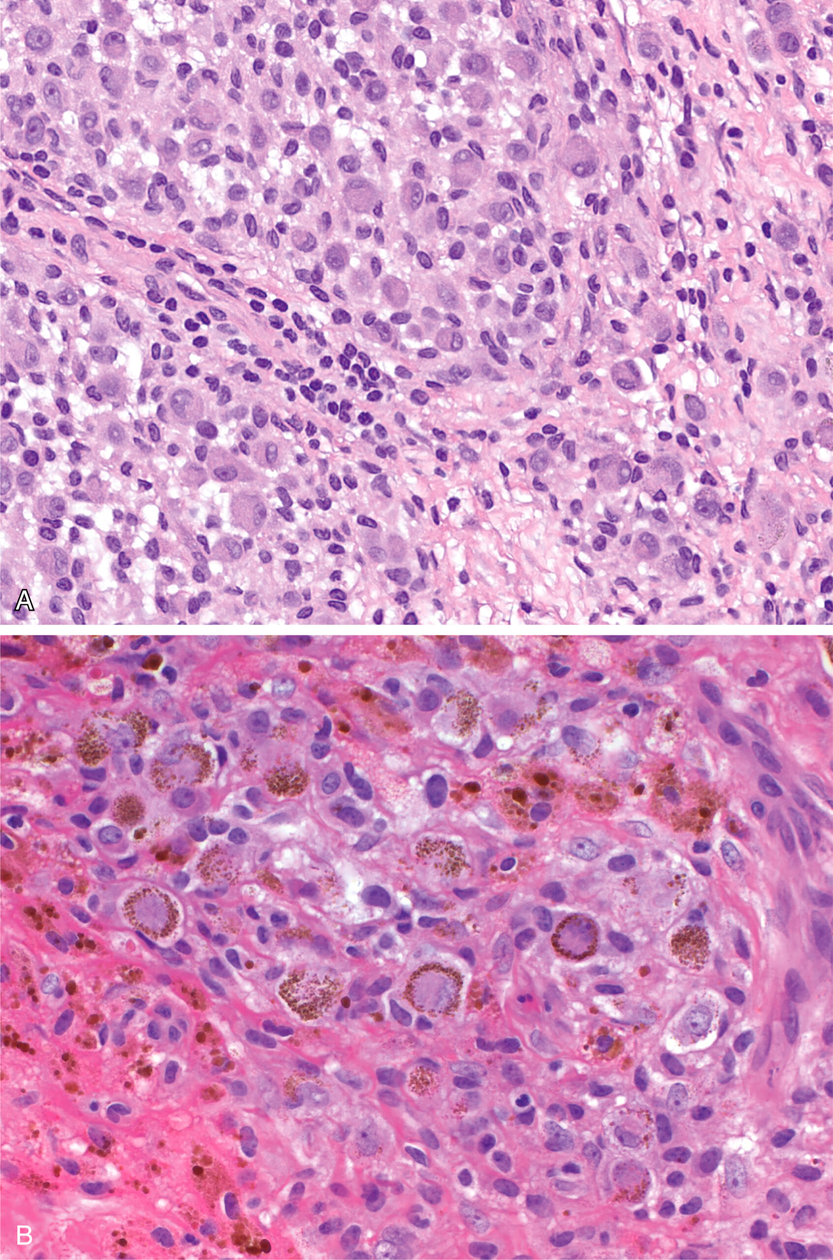 Two microscopic views present synoviocytes with plasmacytoid features and intracytoplasmic hemosiderin in mononuclear cells. The top panel A provides a higher magnification view of synoviocytes, which appear as large, mononuclear cells with a plasmacytoid morphology, characterized by their relatively abundant cytoplasm and distinct nuclei, interspersed within the synovial lining and underlying stroma. The bottom panel B offers a similar high-power perspective, specifically emphasizing hemosiderin-laden synoviocytes, also known as "ladybug cells," which are distinguished by the presence of granular, darkly staining material within their cytoplasm, representing intracellular iron deposits resulting from prior hemorrhage within the synovium.