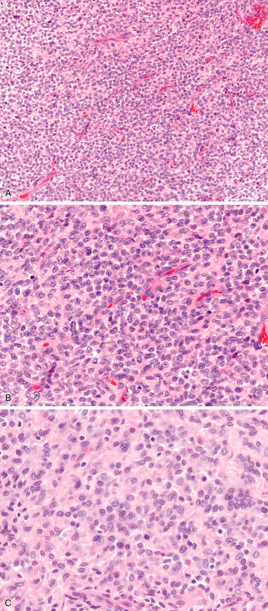 Three microscopic views present rounded cells in a vascular background with dense sheets and visible mitotic figures in some regions. The microscopic images are labeled A, B, and C. The top panel A presents a low-power view of the tumor, characterized by a dense proliferation of predominantly rounded cells embedded within a stroma that appears richly vascularized, indicated by the presence of numerous small blood vessels. The middle panel B offers a higher magnification, illustrating the uniform population of these rounded cells with relatively indistinct cytoplasmic borders and centrally located nuclei, creating a pattern that, particularly in thicker tissue sections, could potentially be mistaken for a malignant round cell tumor due to the high cellularity and monomorphic appearance. The bottom panel C provides an even greater magnification, emphasizing the individual rounded cells and highlighting the presence of mitotic figures, which, if numerous, could further contribute to the diagnostic challenge of distinguishing this variant of T G C T from a more aggressive neoplasm.