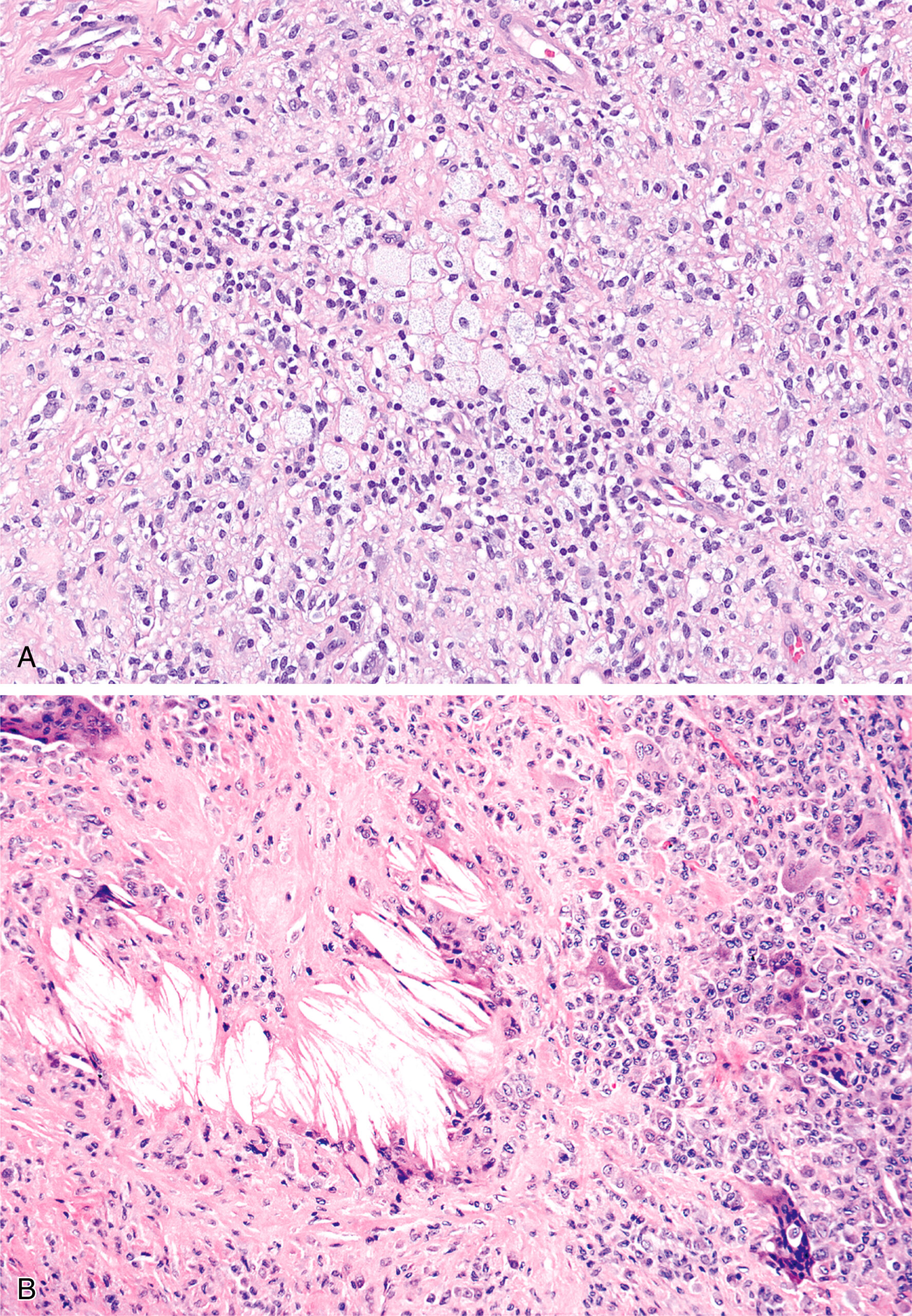Two microscopic views present clusters of lipid-filled macrophages in one section and crystalline cholesterol deposits in the other within cellular tissue. The upper panel A displays a moderately cellular neoplasm composed of small, round to oval cells with hyperchromatic nuclei and scant cytoplasm, arranged in ill-defined lobules separated by delicate fibrovascular stroma, exhibiting a pattern often described as cell nests, characteristic of this olfactory neuroblastoma. The lower panel B offers a similar magnification, revealing areas of the tumor with more prominent stromal changes, including the presence of eosinophilic fibrillary material, possibly representing neuropil, and a notable deposition of crystalline structures, which could be a secondary degenerative change or a less common feature associated with certain neuroblastic tumors.