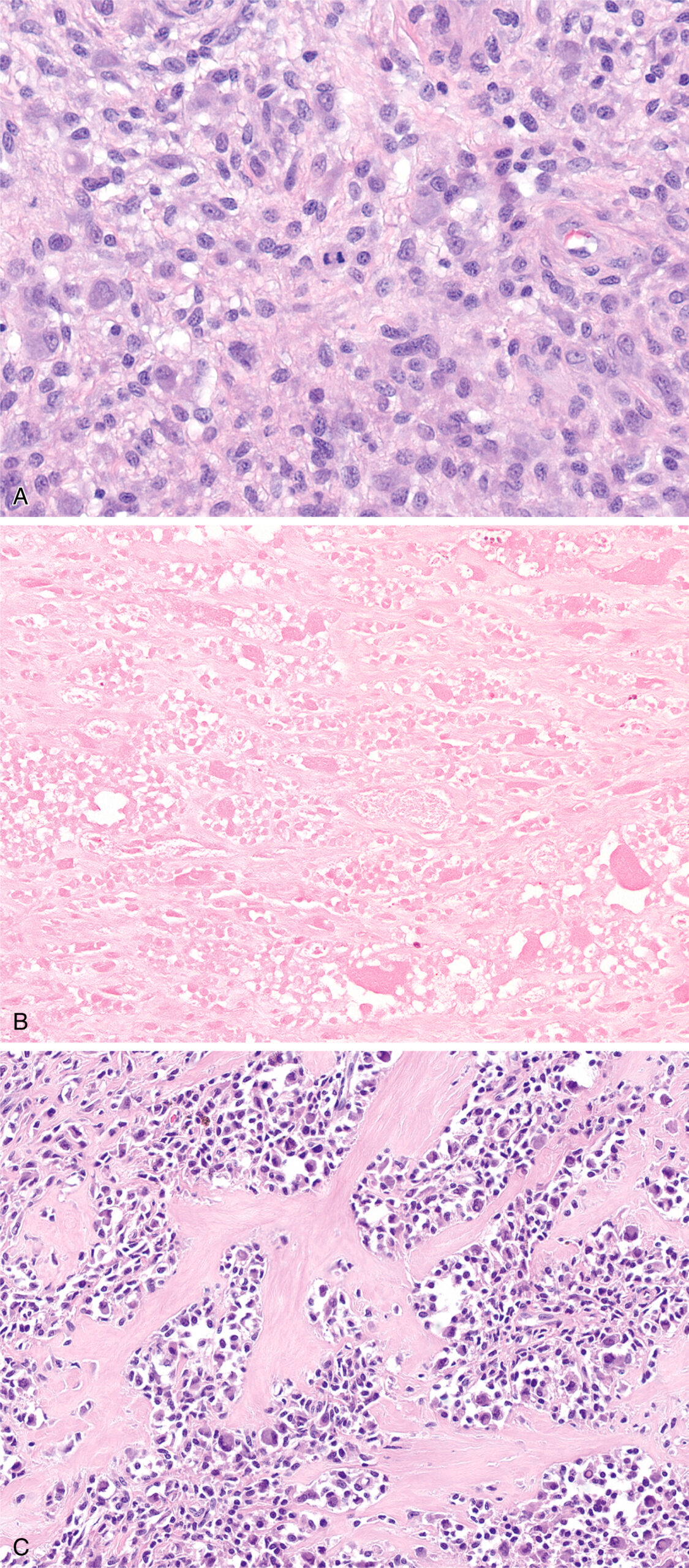 Four microscopic views present mitotically active rounded cells, infarct-like necrotic tissue, and fibrotic areas with a pseudoalveolar arrangement of cells. The four panels are labeled A, B, C, and D. Panel A displays a cellular area within the T G C T exhibiting increased mitotic activity, characterized by several cells with condensed chromatin and visible mitotic spindles, a feature that could raise concern for a more aggressive neoplasm. Panel B reveals a zone of infarct-type necrosis within the tumor, showing a pale, acellular region with preserved tissue outlines and surrounding viable tumor cells, a pattern of cell death that, while seen in benign lesions, can also be associated with malignancy. Panel C illustrates areas of hyalinization, characterized by dense, acellular, glassy material, and a pseudoalveolar change where tumor cells are arranged around these hyalinized zones, creating a pattern that can superficially resemble the appearance of rhabdomyosarcoma, a malignant soft tissue tumor. Panel D displays vascular space invasion with clusters of rounded cells within a fibrotic stroma and tumor cells invading vascular lumina.