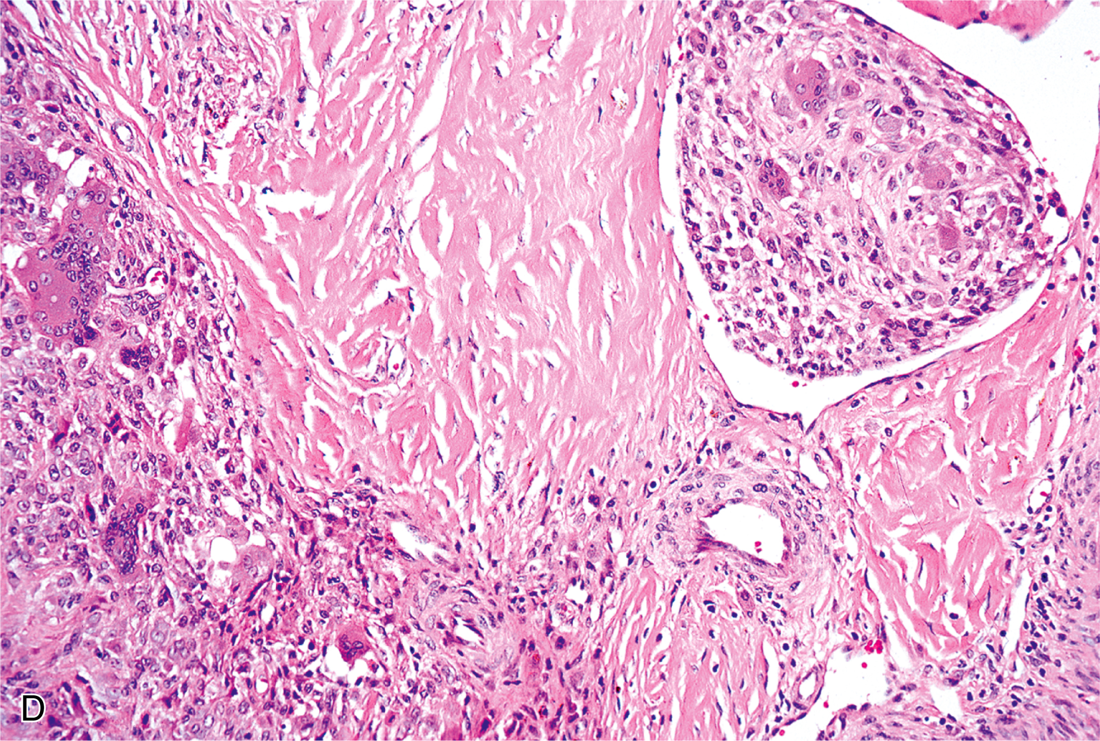 Four microscopic views present mitotically active rounded cells, infarct-like necrotic tissue, and fibrotic areas with a pseudoalveolar arrangement of cells. The four panels are labeled A, B, C, and D. Panel A displays a cellular area within the T G C T exhibiting increased mitotic activity, characterized by several cells with condensed chromatin and visible mitotic spindles, a feature that could raise concern for a more aggressive neoplasm. Panel B reveals a zone of infarct-type necrosis within the tumor, showing a pale, acellular region with preserved tissue outlines and surrounding viable tumor cells, a pattern of cell death that, while seen in benign lesions, can also be associated with malignancy. Panel C illustrates areas of hyalinization, characterized by dense, acellular, glassy material, and a pseudoalveolar change where tumor cells are arranged around these hyalinized zones, creating a pattern that can superficially resemble the appearance of rhabdomyosarcoma, a malignant soft tissue tumor. Panel D displays vascular space invasion with clusters of rounded cells within a fibrotic stroma and tumor cells invading vascular lumina.