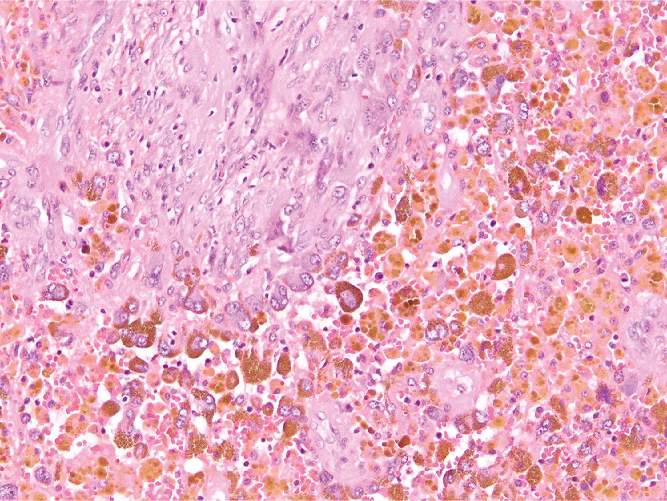 A microscopic image displays a dense accumulation of hemosiderin-laden macrophages in the lower half of the field.