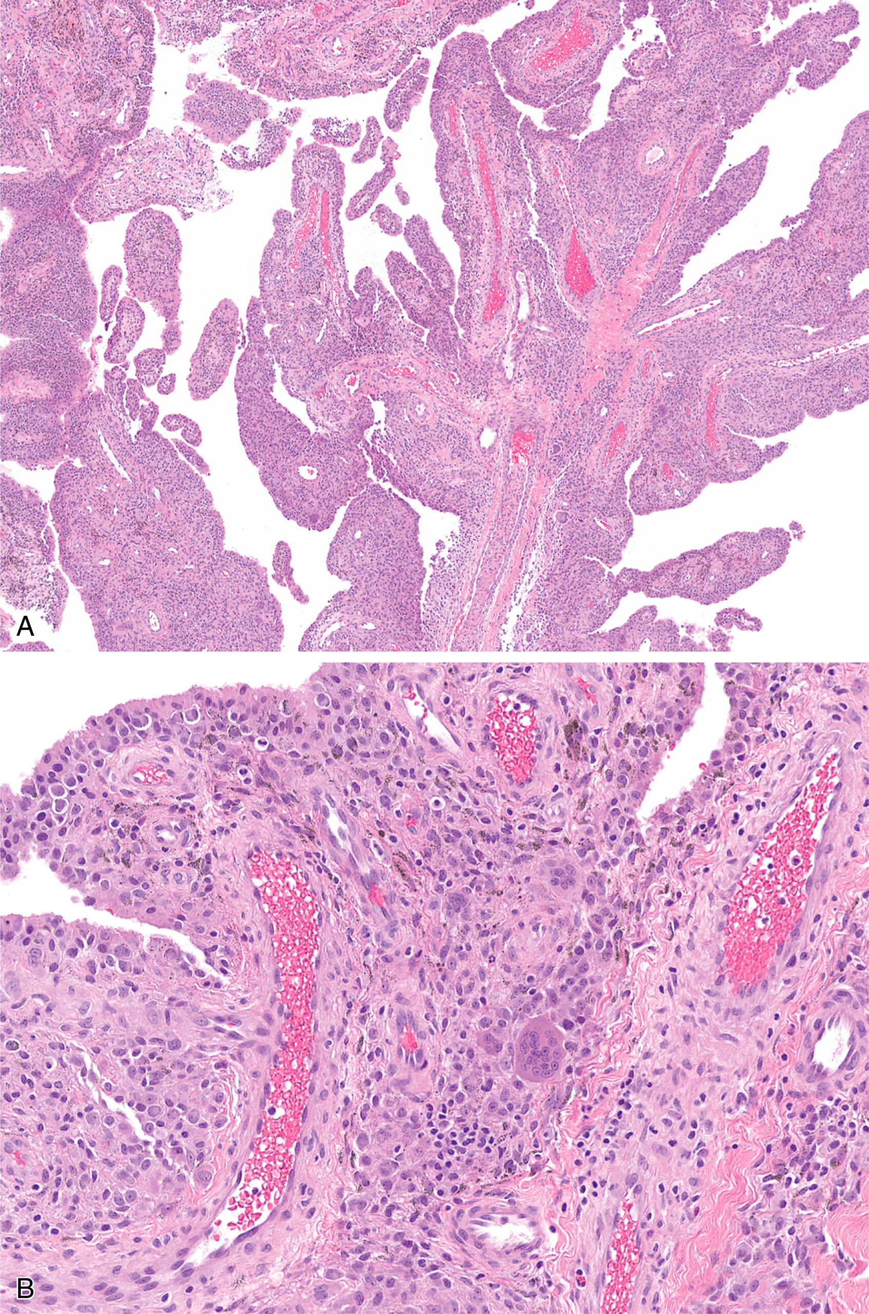 Two microscopic images labeled A and B display villiform projections and sub-synovial connective tissue replaced by synoviocytes, histiocytes, and osteoclast-like giant cells.