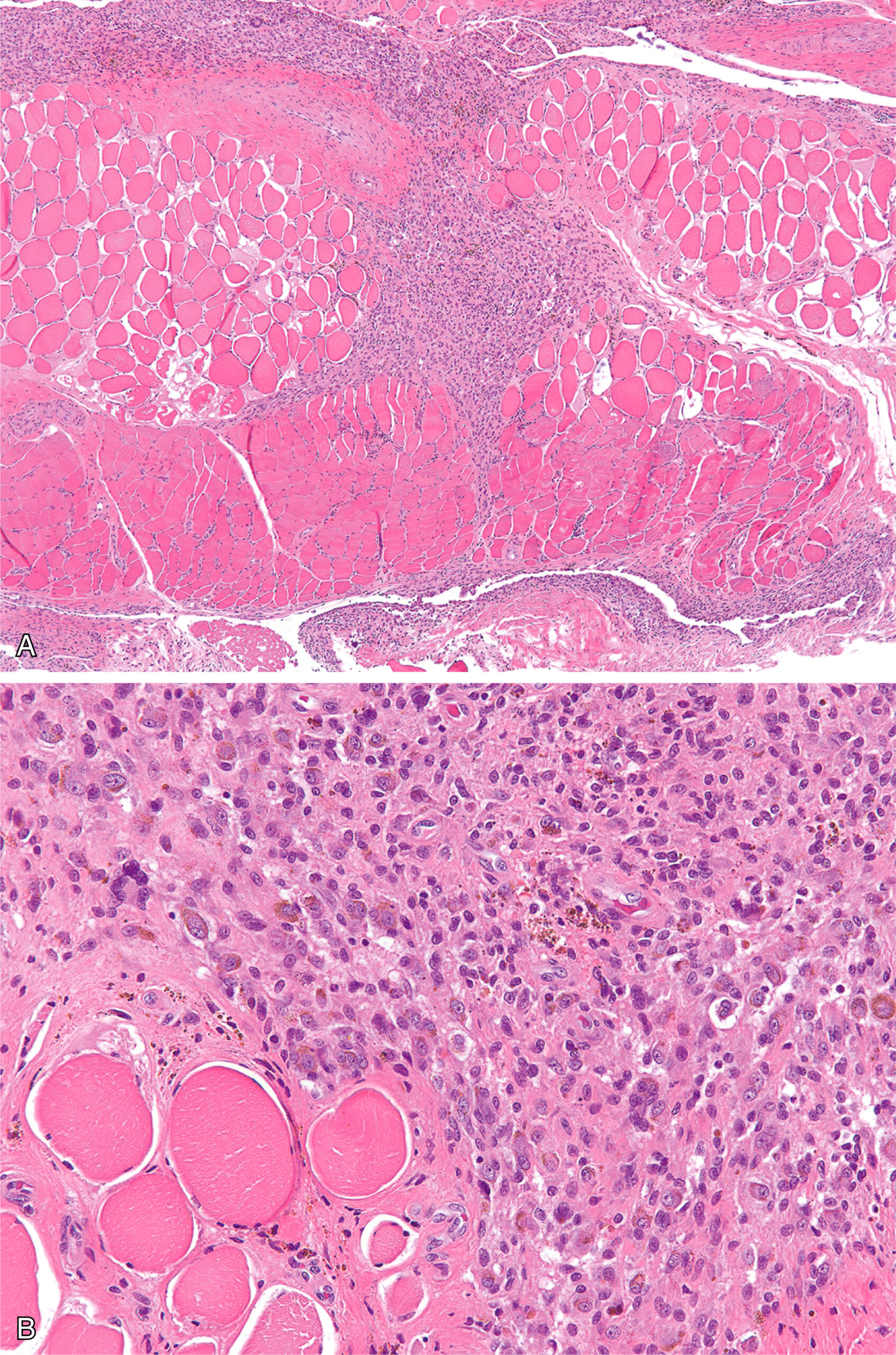 Two microscopic panels, A and B, show infiltrative growth of extraarticular diffuse tenosynovial giant cell tumor with involvement of skeletal muscle fibers.