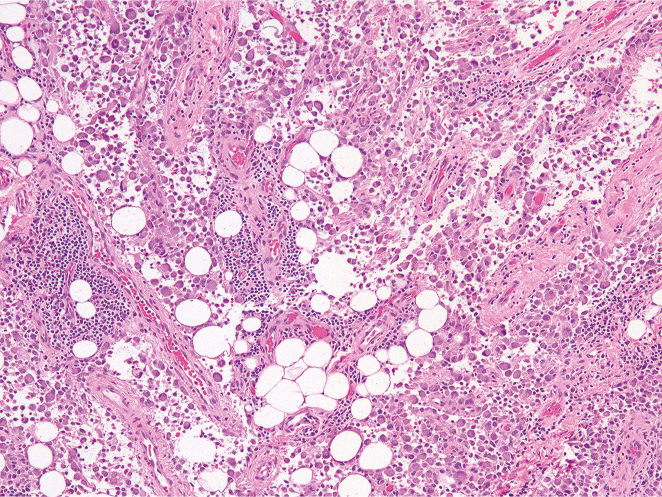 A microscopic image displays a diffuse tenosynovial giant cell tumor with cellular infiltration into surrounding adipose tissue.