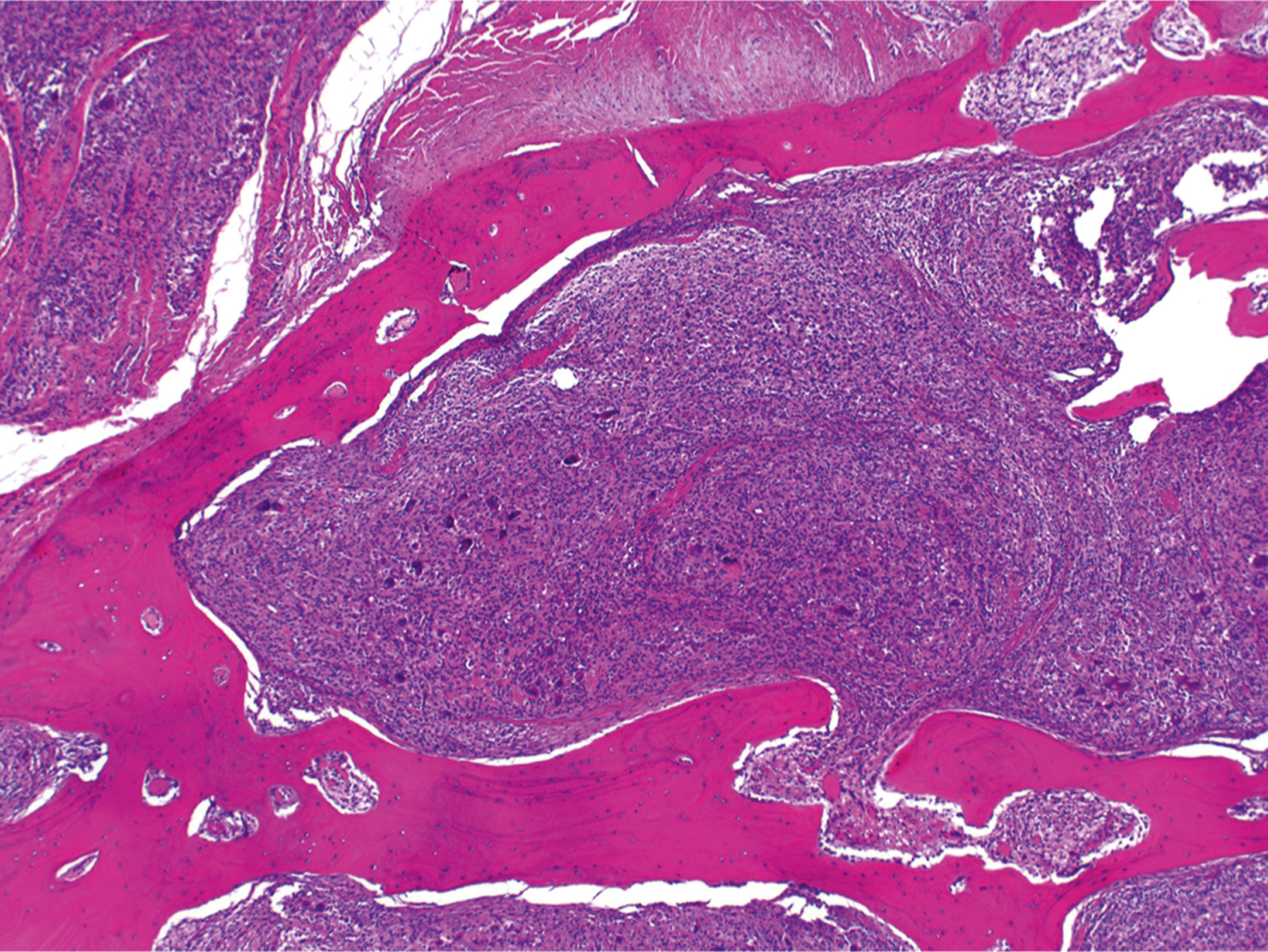 A microscopic image displays an intraarticular diffuse tenosynovial giant cell tumor with extension into surrounding bone structures.