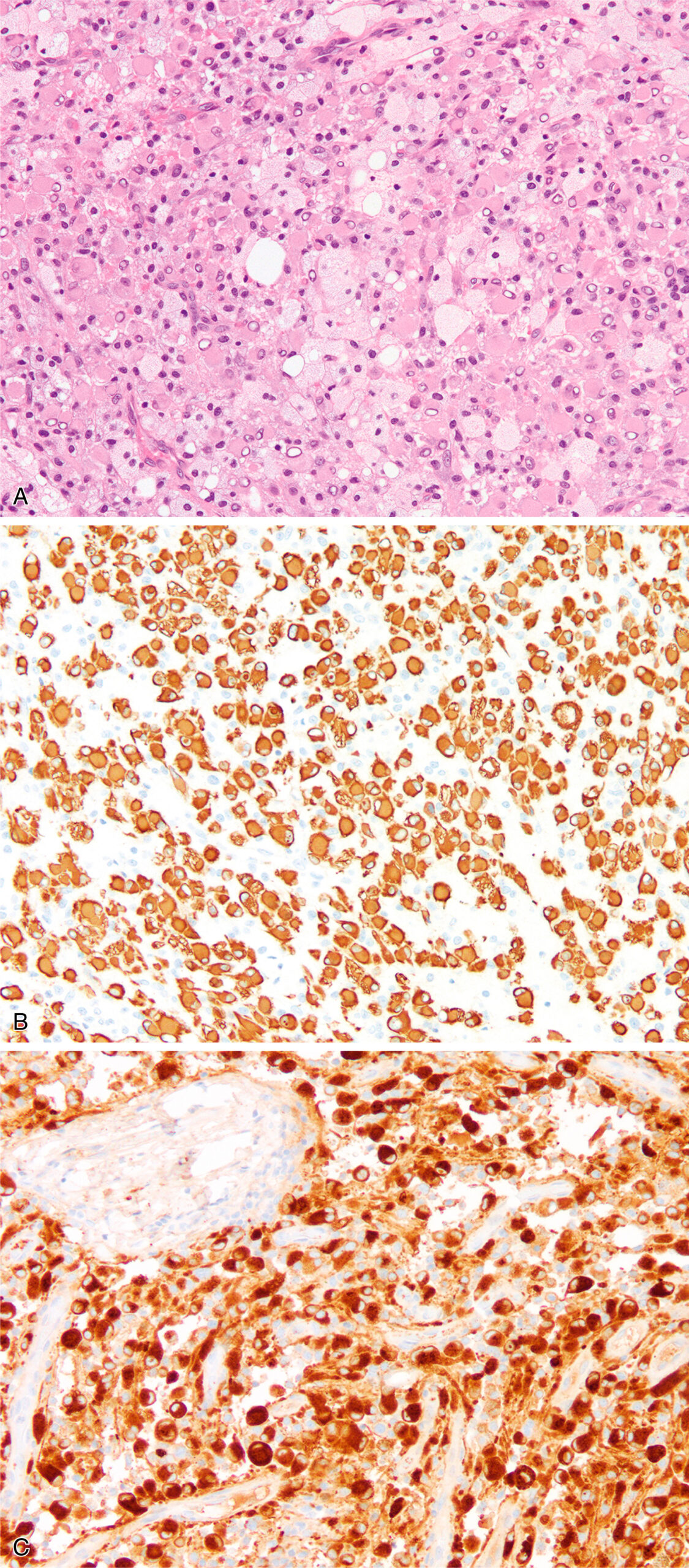 Three panels display rhabdoid synoviocytes in diffuse tenosynovial giant cell tumors with desmin and clusterin immunostaining. The top panel A presents a histologic section of diffuse tenosynovial giant cell tumor containing numerous large rhabdoid synoviocytes with abundant granular cytoplasm and eccentric nuclei, scattered among a background of mononuclear histiocyte-like cells and occasional multinucleated giant cells. These cells appear more prominent due to their distinct morphology. The middle panel B presents immunohistochemical staining for desmin, which demonstrates strong cytoplasmic positivity in the rhabdoid synoviocytes, contrasting with the unstained or weakly stained background cells. This highlights a potential diagnostic pitfall, as such staining may mimic rhabdomyosarcoma. The bottom panel C contains immunohistochemical staining for clusterin, where the same rhabdoid synoviocytes display diffuse cytoplasmic expression. The clusterin positivity supports a synoviocytic origin and helps distinguish these cells from other soft tissue tumor lineages.
