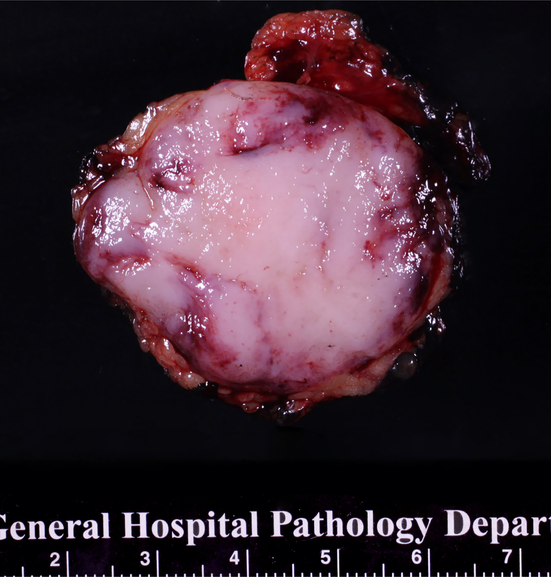 A gross specimen of a round soft tissue mass with a fleshy cut surface and heterogeneous texture is placed above a measurement scale.