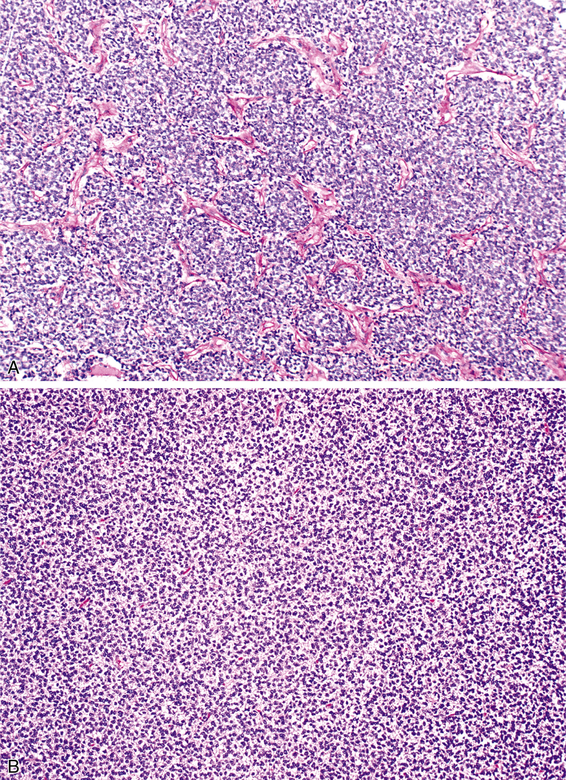A set of two microscopic views of a round cell tumor with a lobular pattern in the upper panel and a monotonous cell population in the lower panel.