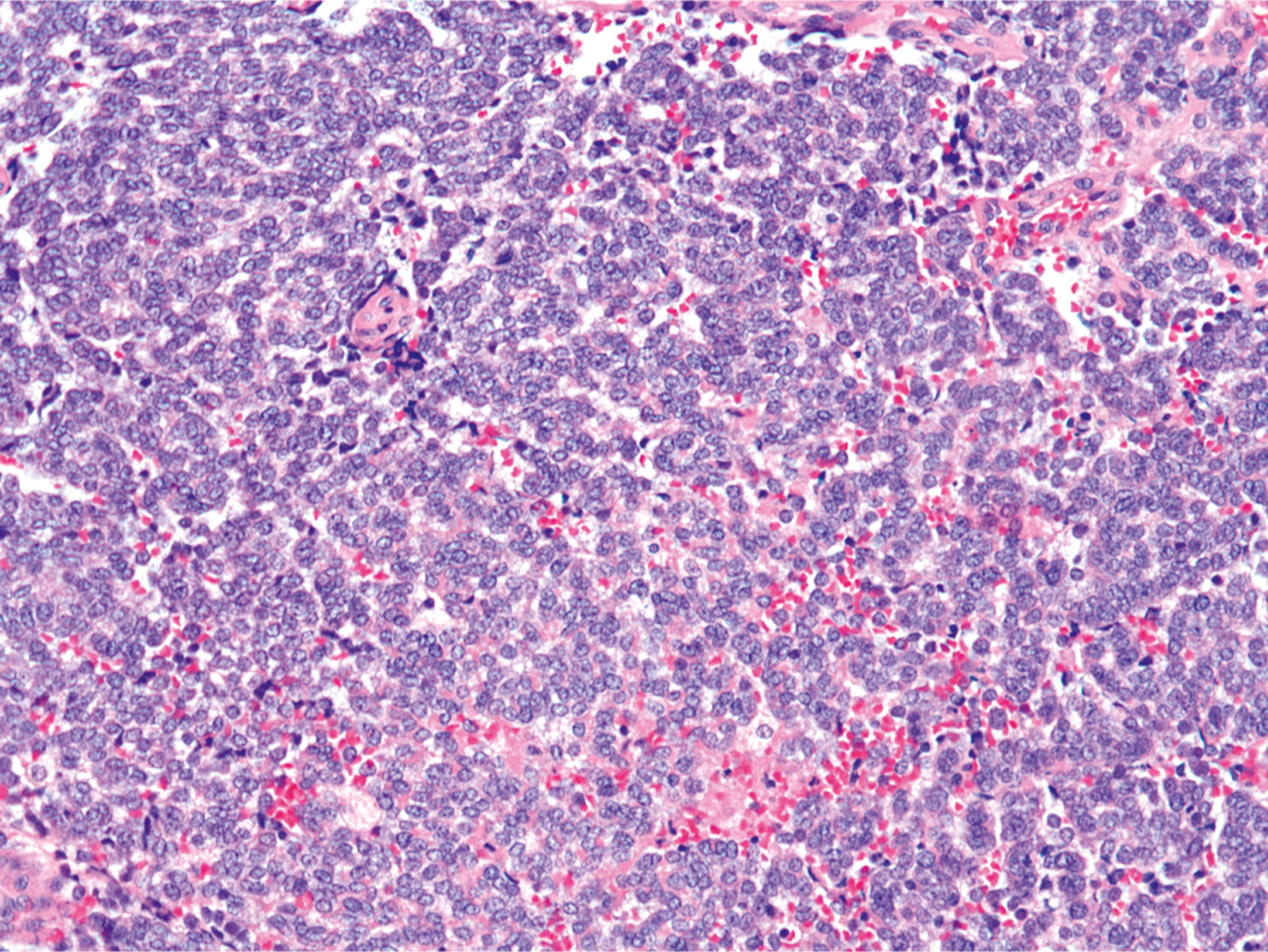 A microscopic section of a tumor composed of sheets of uniform round cells with a high nuclear to cytoplasmic ratio and scattered blood vessels.