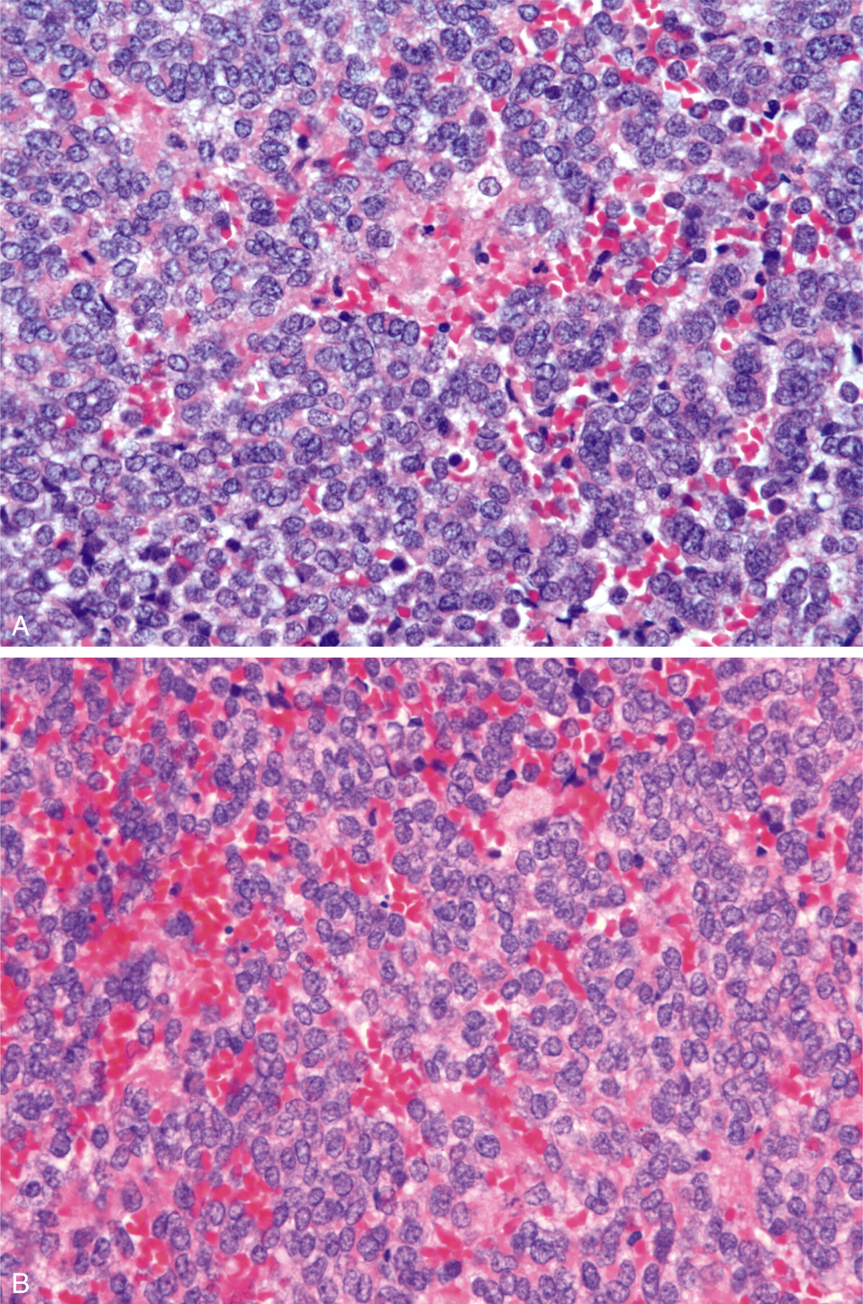 A set of two microscopic sections of the tumor with primitive round cells having fine chromatin and round nuclei, with scattered blood vessels and areas of hemorrhage.