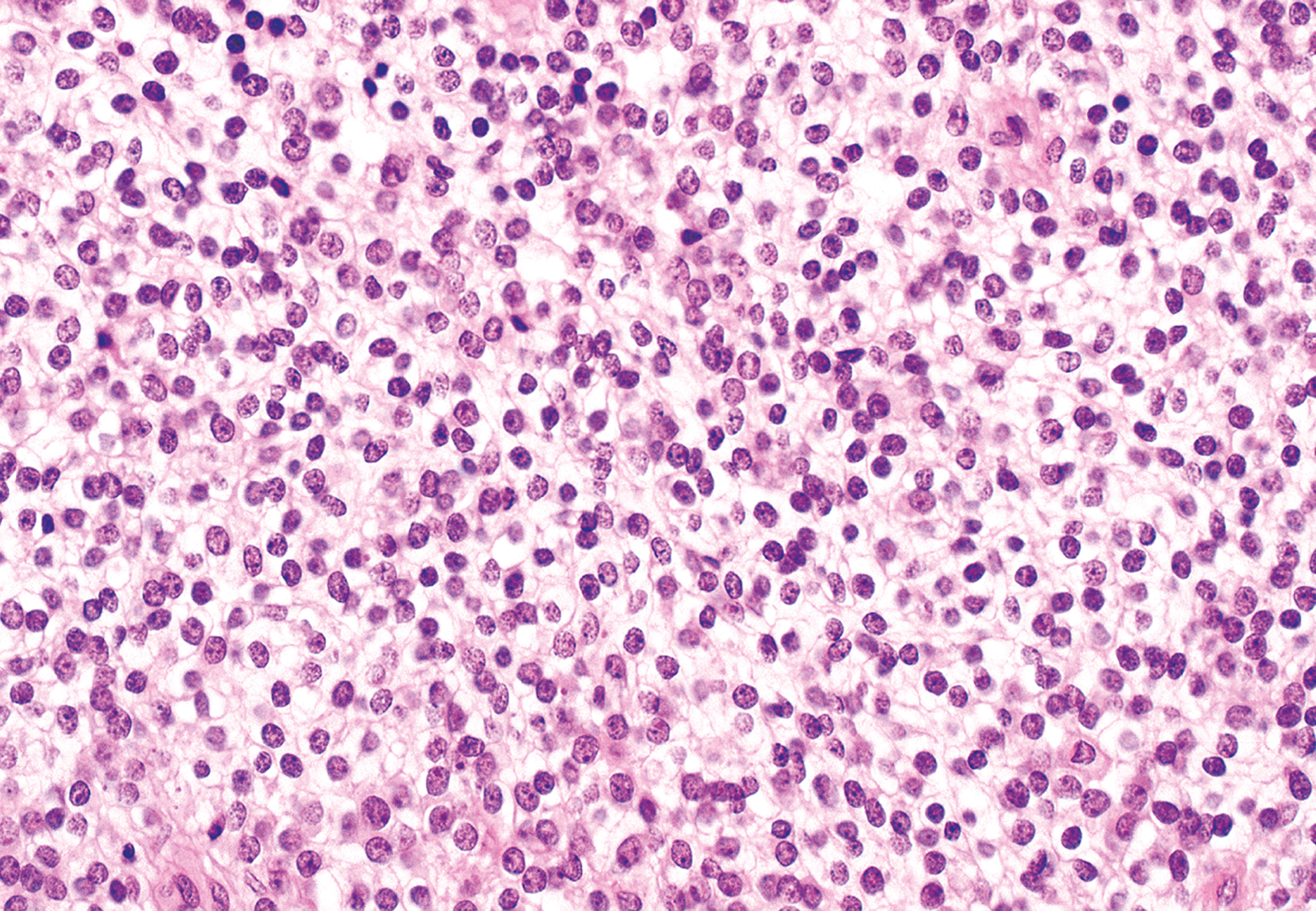 A microscopic section of a tumor containing round cells with clear cytoplasm and uniform nuclei scattered throughout a loosely arranged background.