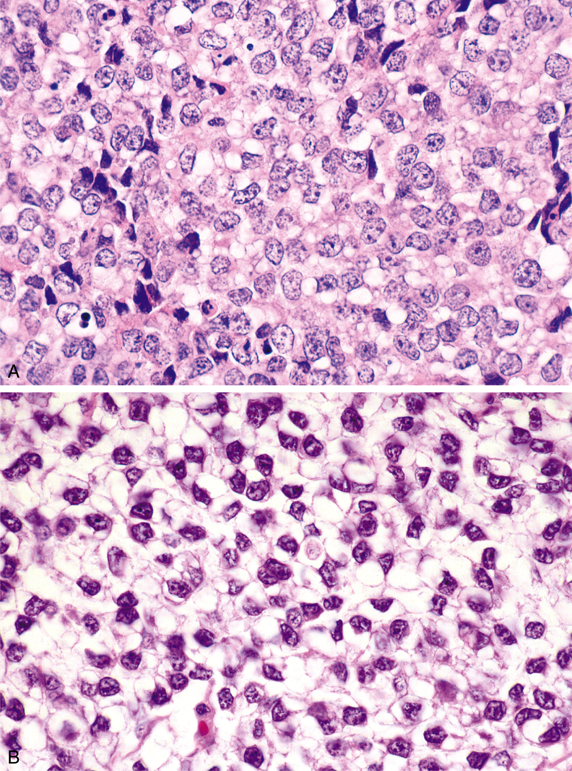 A set of two views of tumor cells with abundant cytoplasmic vacuoles and centrally placed nuclei, some of which are indented by vacuolar spaces.