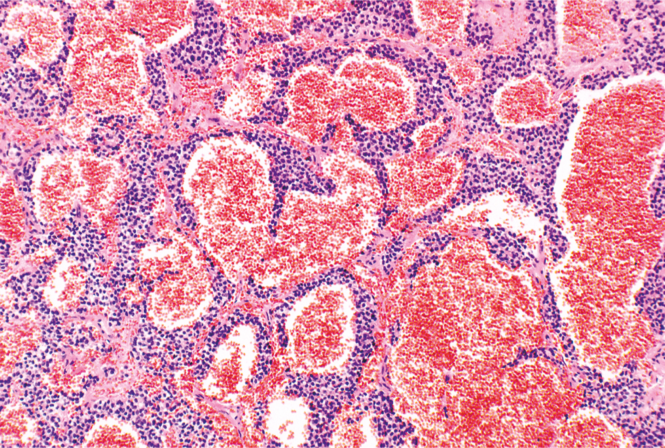 A microscopic view of hemorrhagic areas surrounded by densely packed small round tumor cells in extraskeletal Ewing sarcoma, forming vascular-like spaces.