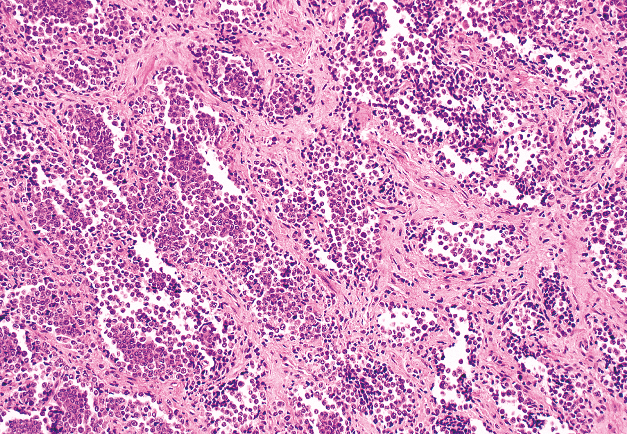 A microscopic view of alveolar pattern with clusters of small round cells separated by fibrous septa and areas of degeneration in Ewing sarcoma.