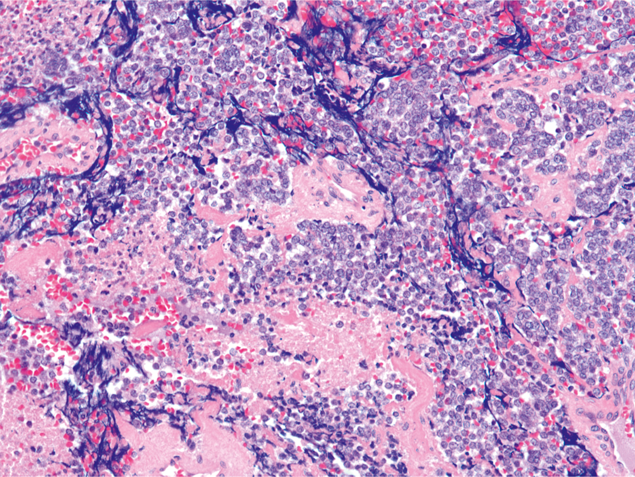 A microscopic view of Ewing sarcoma with extensive necrotic areas and scattered small round crushed tumor cells surrounded by fibrous stroma.