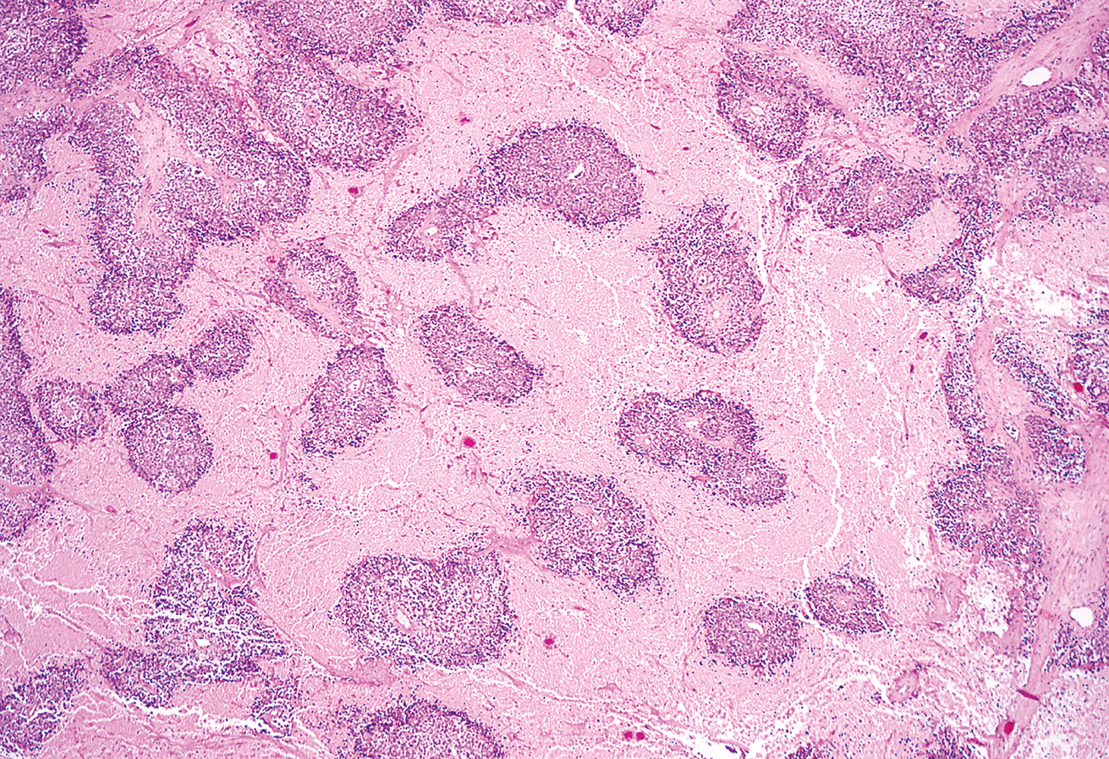 A section of Ewing sarcoma where multiple round and irregularly shaped clusters of viable tumor cells are arranged throughout the tissue.