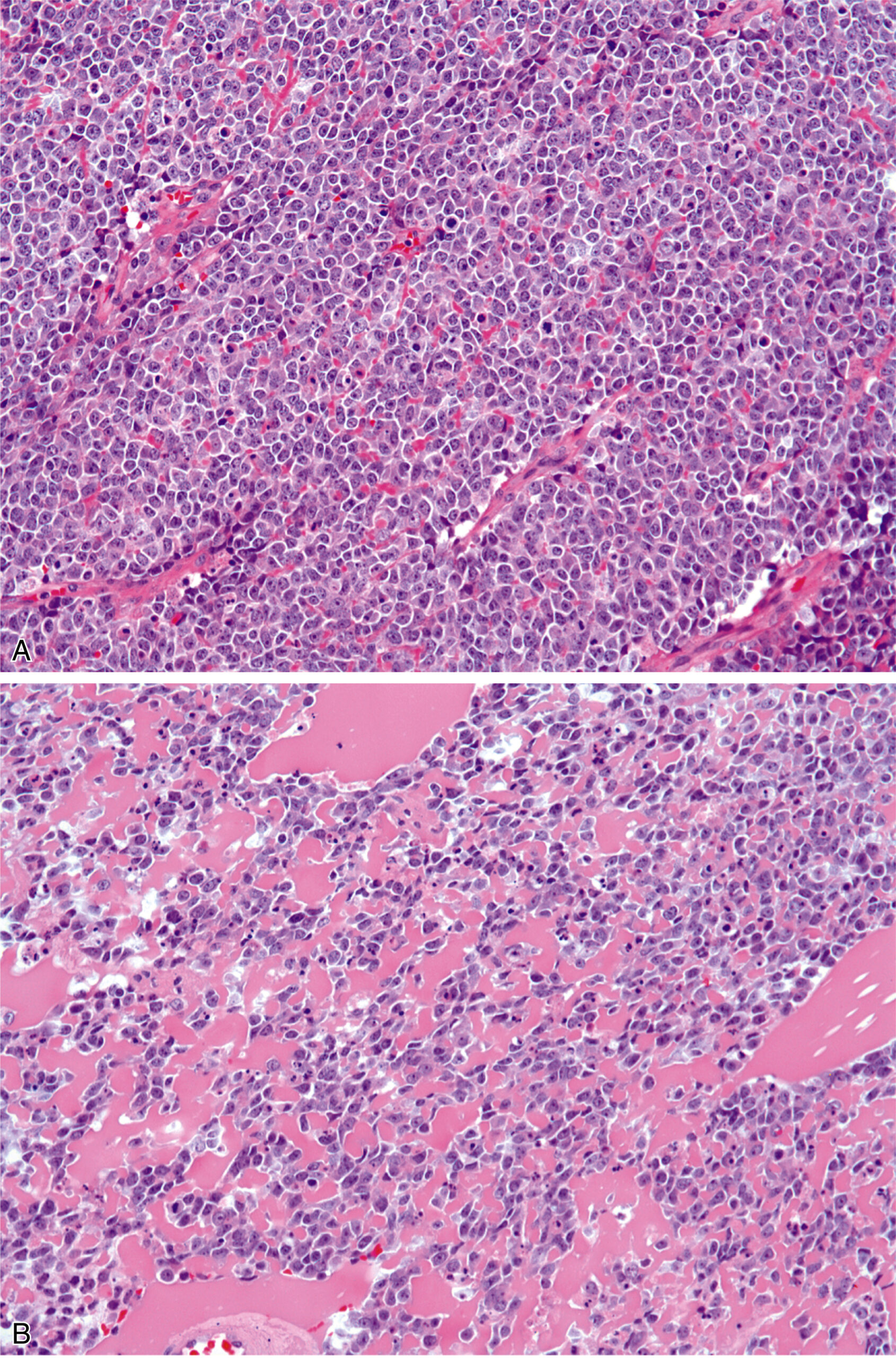 A set of two sections of Ewing sarcoma with sheets of large round cells with vesicular nuclei and prominent nucleoli, separated by delicate fibrovascular stroma.