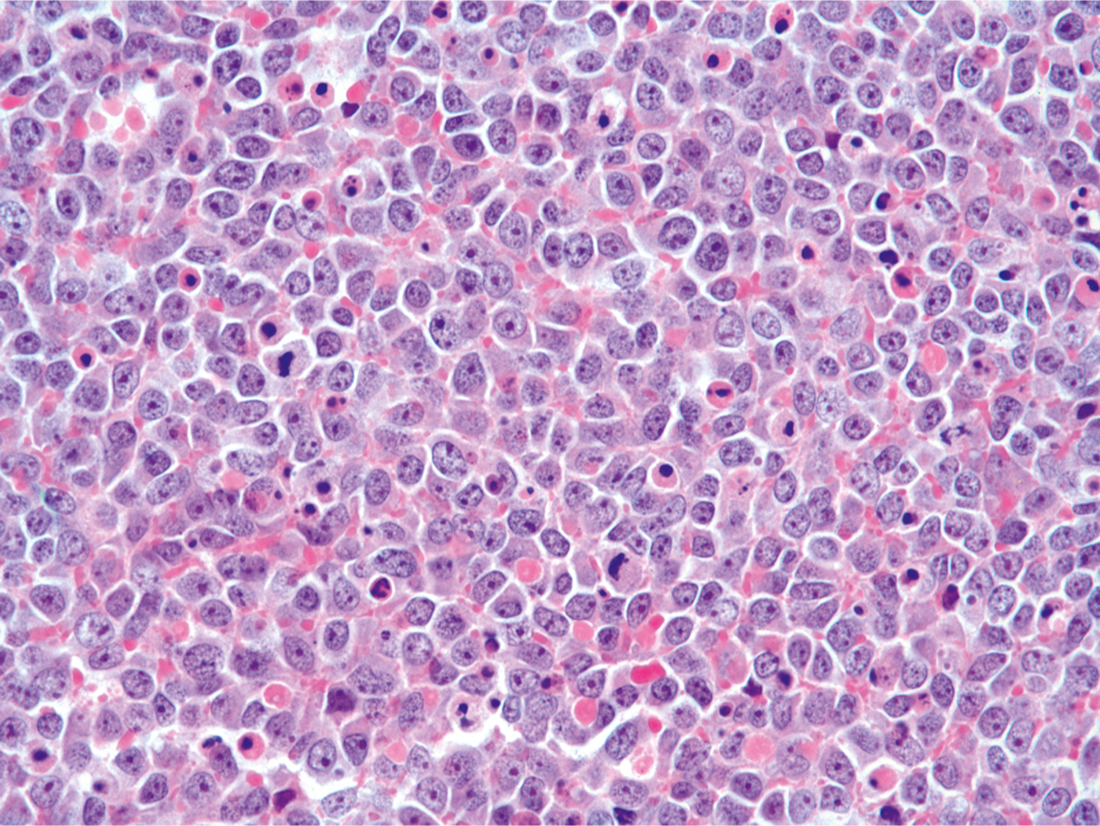 A high-power view of large cell Ewing sarcoma consists of sheets of tumor cells with round to oval vesicular nuclei, prominent nucleoli, and moderate to abundant cytoplasm.