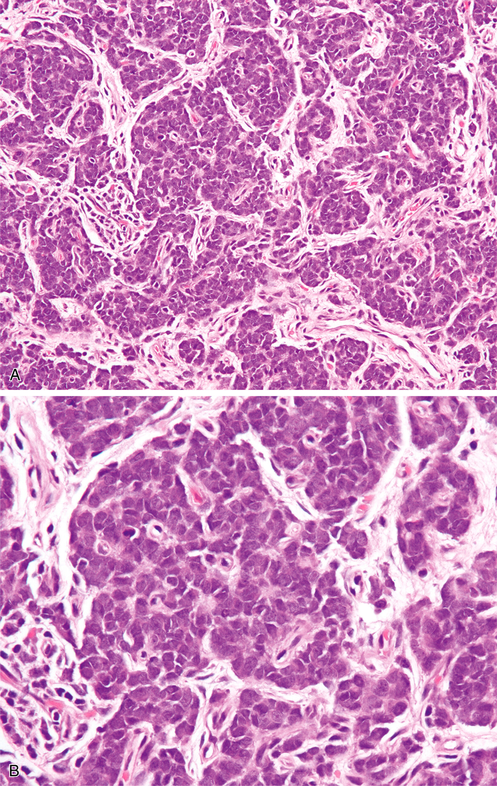 A set of two views of adamantinoma-like Ewing sarcoma with nests of small round cells surrounded by dense fibrous stroma in a nested growth pattern.