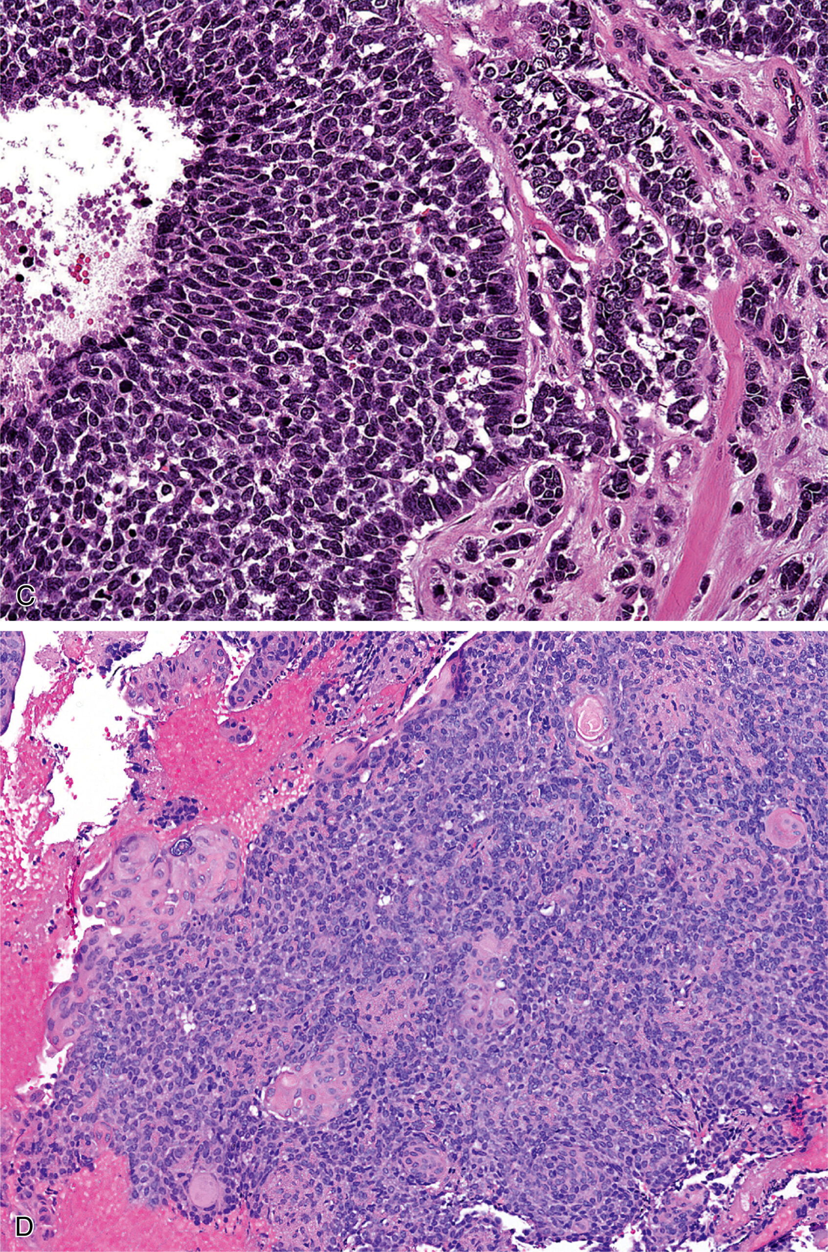 A set of two views of adamantinoma-like Ewing sarcoma with nests of small round cells surrounded by dense fibrous stroma in a nested growth pattern.