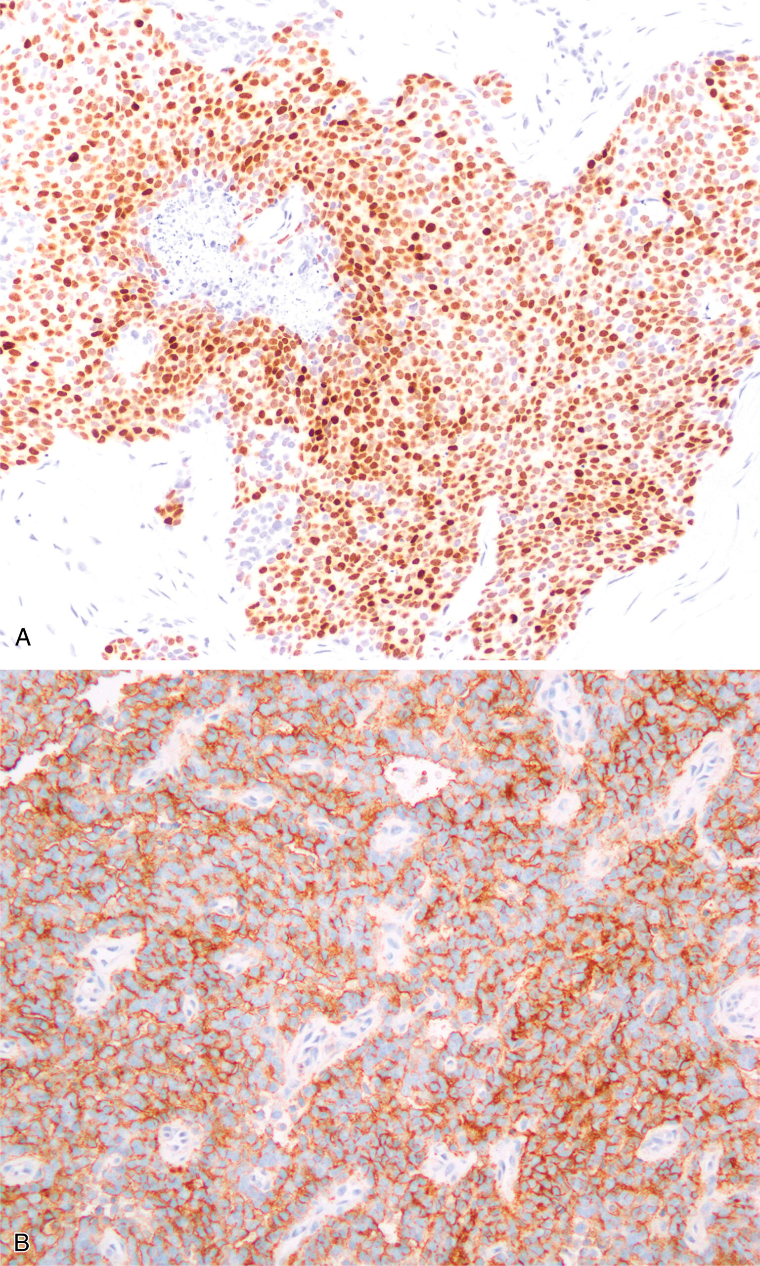 A set of two pictures of adamantinoma-like Ewing sarcoma with nuclear expression in one and membranous expression in the other in immunohistochemical staining.
