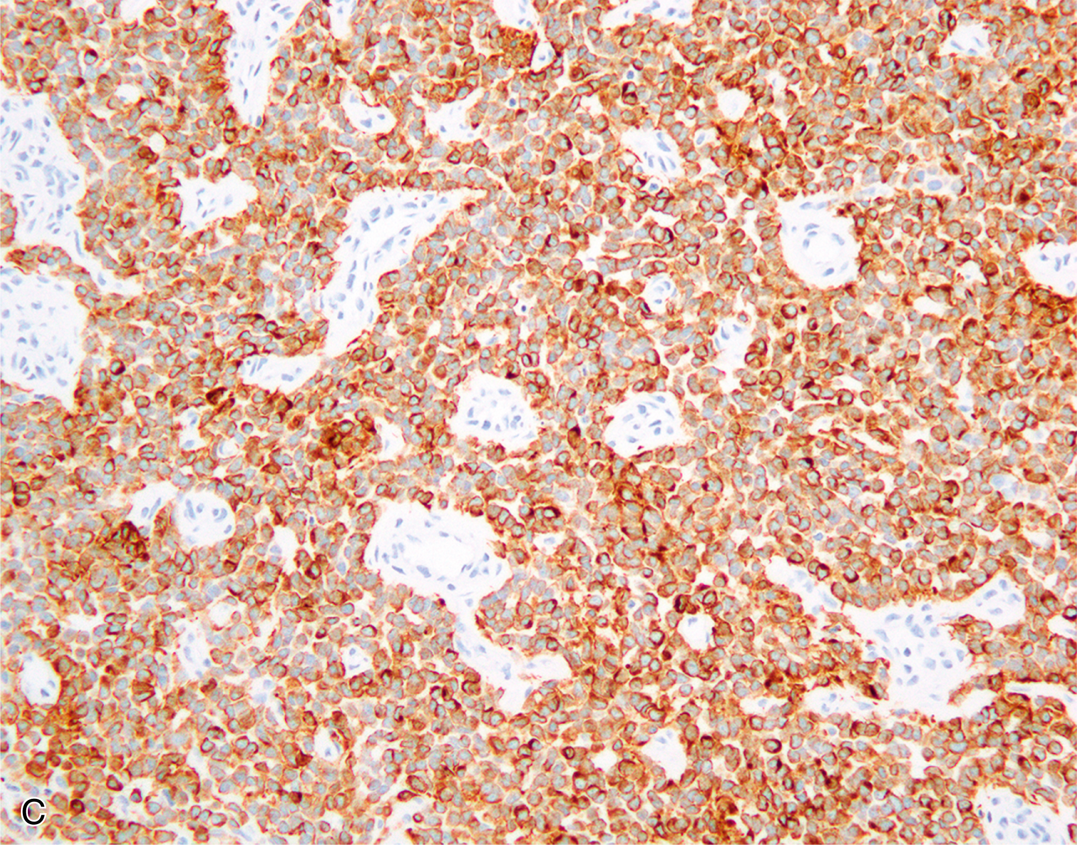 A set of two pictures of adamantinoma-like Ewing sarcoma with nuclear expression in one and membranous expression in the other in immunohistochemical staining.