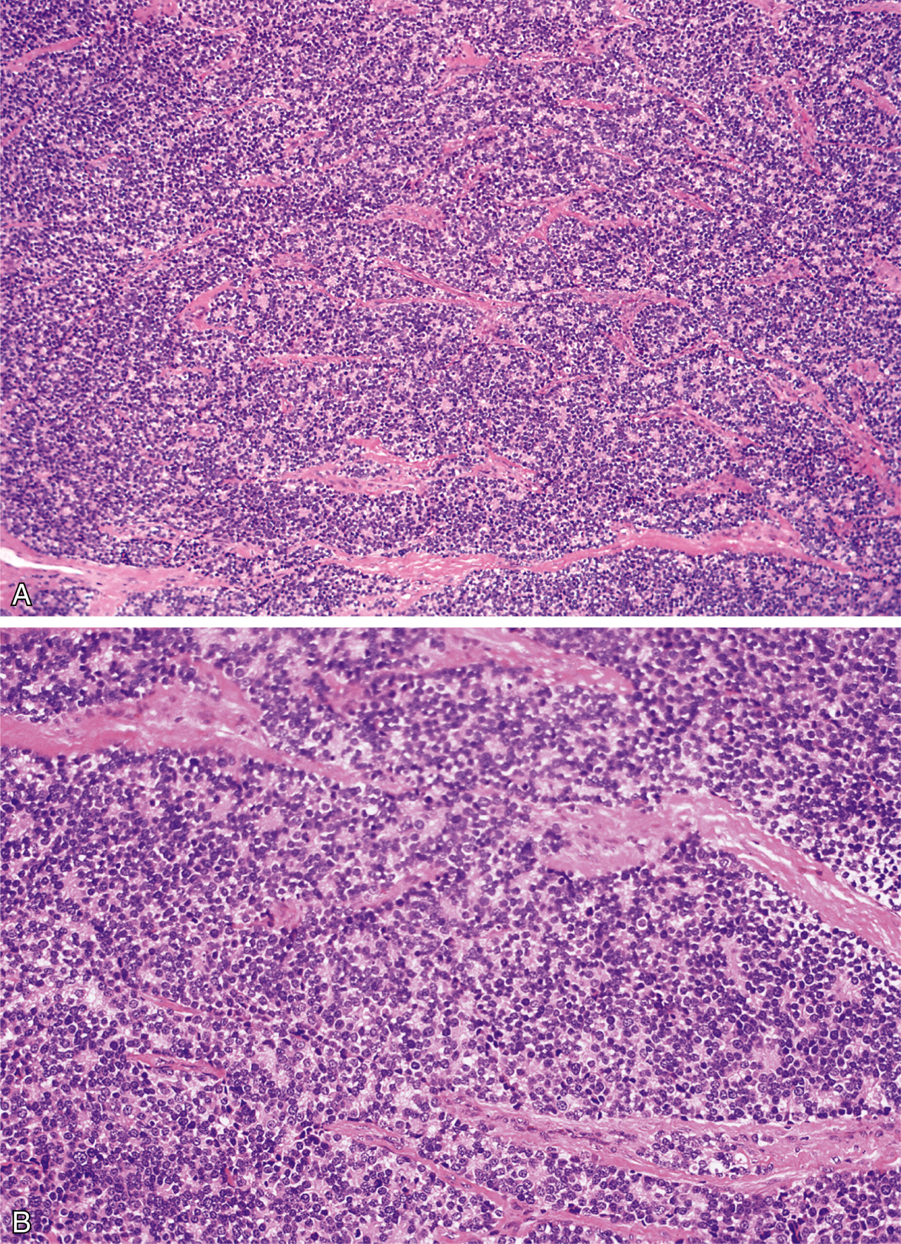 A set of two microscopic views of lobulated tumor tissue with uniform small round cells and multiple Homer Wright rosettes separated by fibrous septa.