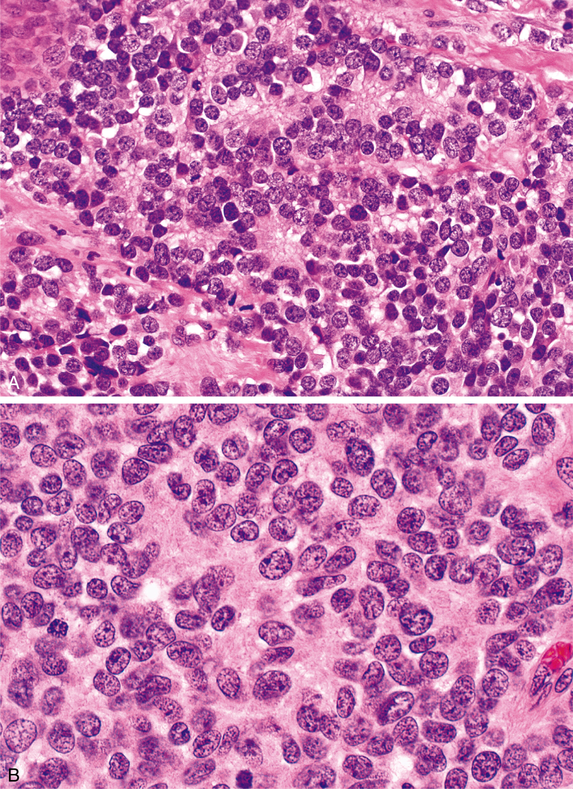 A set of two pictures of densely packed small round tumor cells with circular arrangements around central fibrillary spaces, indicating Homer Wright rosettes.