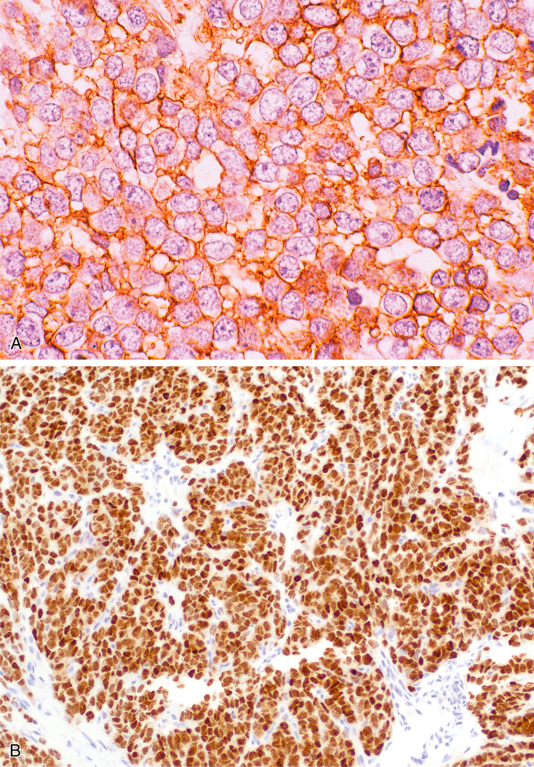 A set of two pictures of densely packed tumor cells with strong membranous staining and uniform nuclear expression in Ewing sarcoma tissue sections.