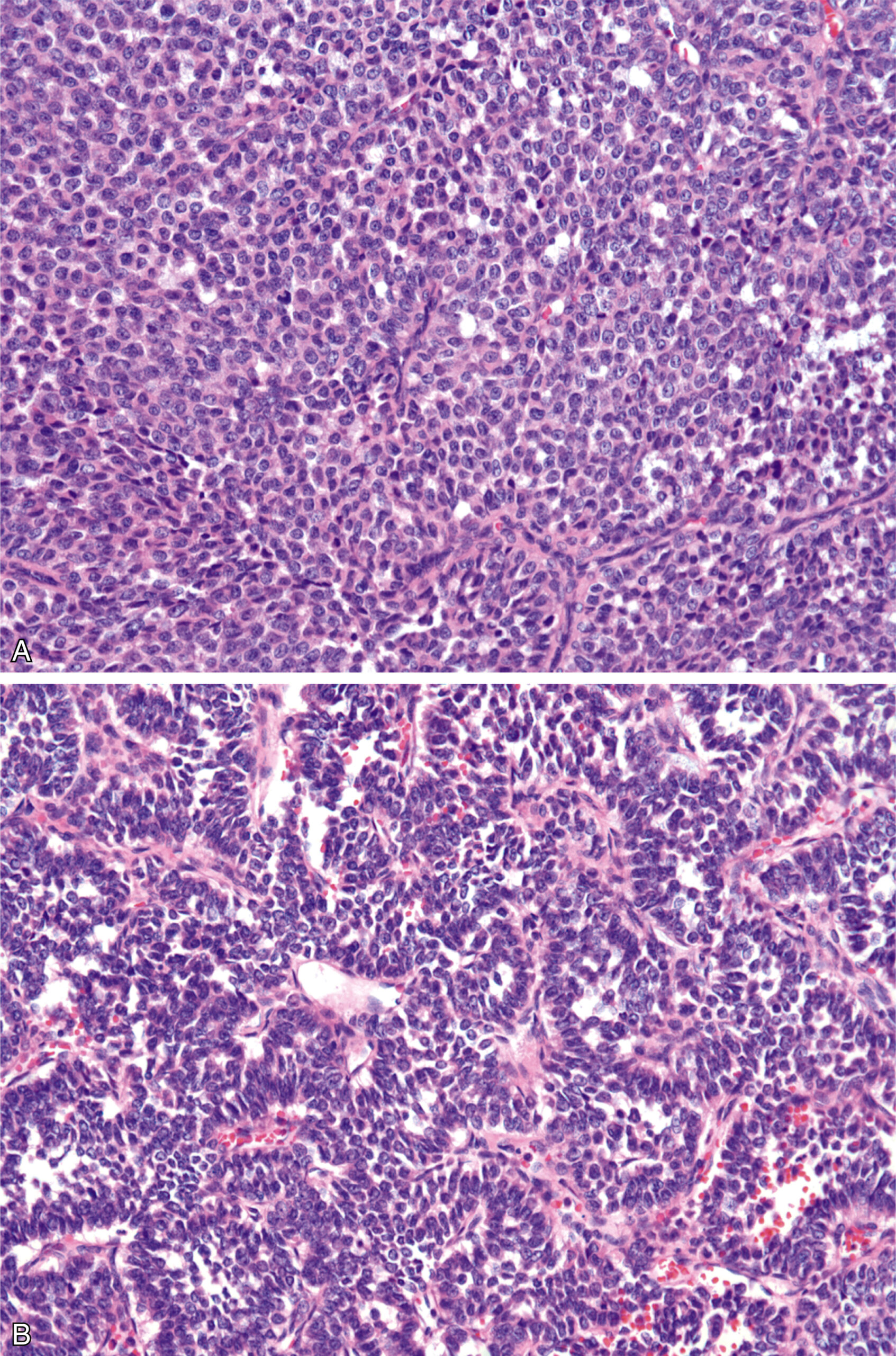 A set of two histologic sections of a tumor with a nested pattern in the upper section and a pseudopapillary pattern in the lower section. The set of two histologic sections present tumor tissues. The upper section, labeled A, shows a tumor with a nested pattern of uniform round to oval cells in discrete clusters separated by fibrous septae. Nuclei are densely packed with minimal cytoplasm, and the stroma is scant without mucin. The lower section, labeled B, reveals a pseudopapillary pattern, with tumor cells loosely arranged around fibrovascular cores, forming false papillae. The tumor is hypercellular, with more separation between cell groups than in the upper section. Delicate vascular structures are seen in the background.