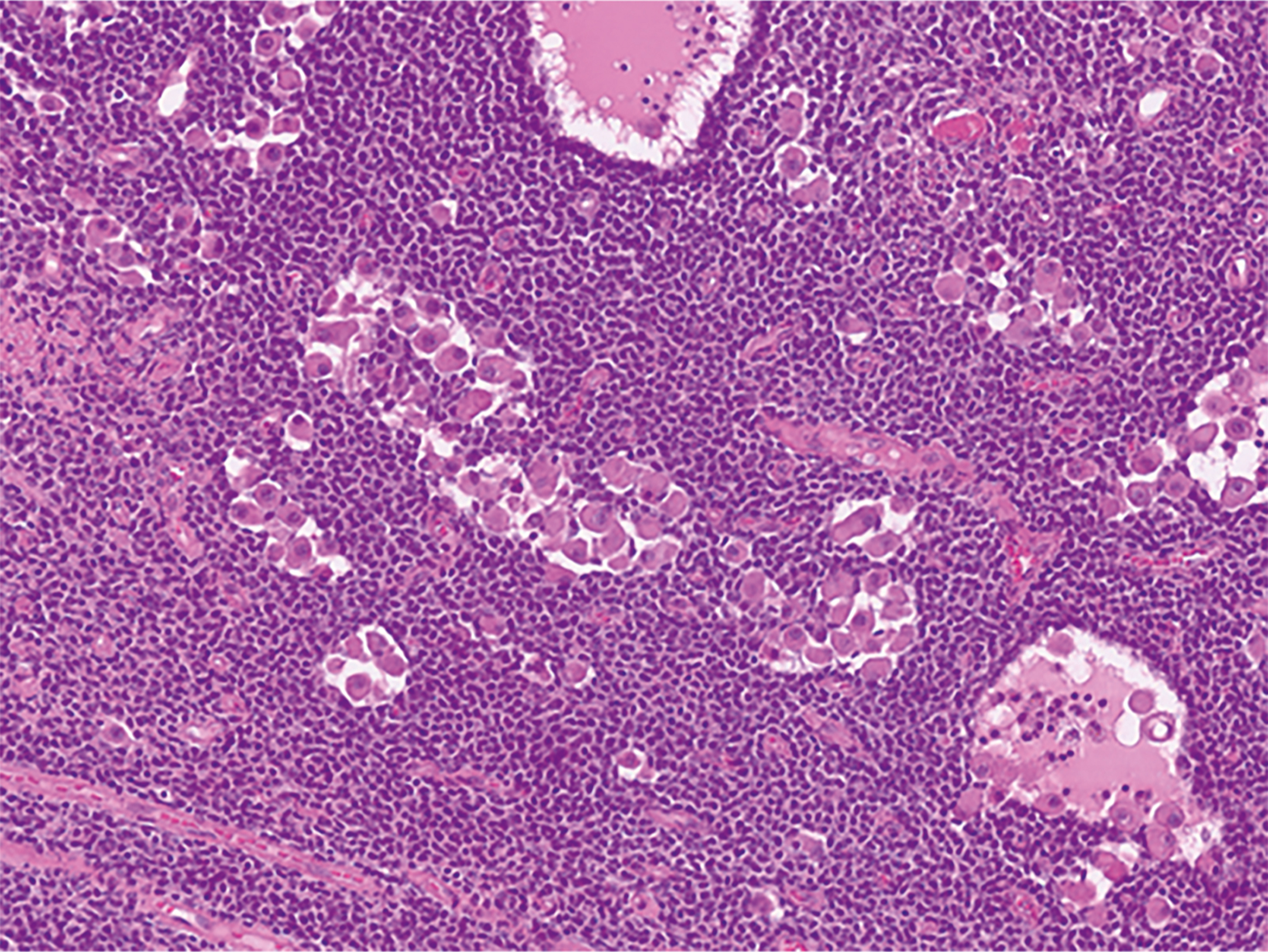 A histologic section of P O Z A T-hook-containing Zinc finger protein 1 rearranged tumor with scattered, light-stained large cells within a dense dark tumor cell background.