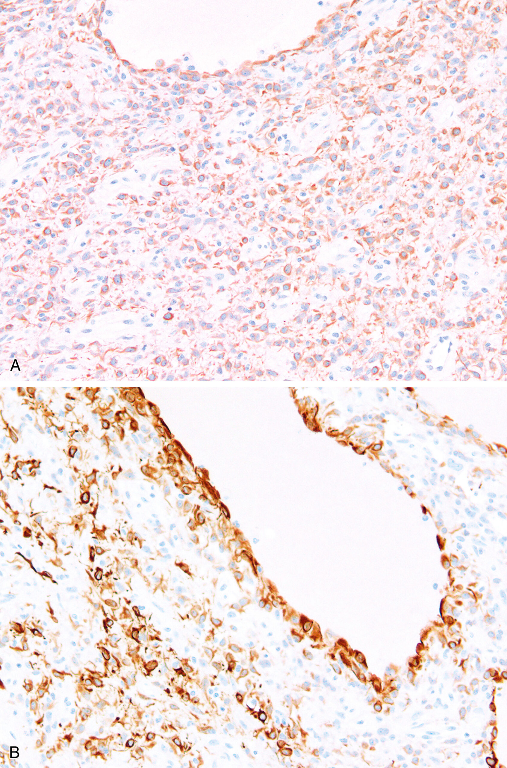 Two histologic sections of P O Z AT-hook-containing Zinc finger protein 1 rearranged tumor with glial fibrillary acidic protein expression in one and desmin expression in another. The two histologic sections present tumor tissues. The first section, labeled A, presents a P O Z AT-hook-containing Zinc finger protein 1 rearranged tumor with scattered tumor cells displaying cytoplasmic glial fibrillary acidic protein expression. The tumor cells are arranged in a disorganized pattern with moderate nuclear pleomorphism. The background stroma appears infiltrated by reactive cells. In the second section, labeled B, tumor cells surround a vascular structure and exhibit strong cytoplasmic expression of desmin. The staining pattern outlines individual cells and highlights their interaction with the surrounding vascular structures. Both sections demonstrate the presence of co-expression of different lineage markers in the same tumor type.